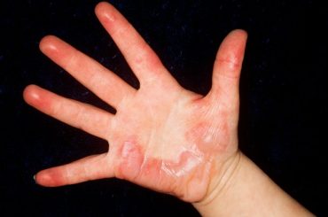 Treating Burns and Scalds Correctly